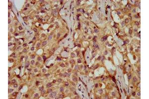 IHC image of ABIN7149571 diluted at 1:200 and staining in paraffin-embedded human liver cancer performed on a Leica BondTM system. (PDSS2 抗体  (AA 292-387))