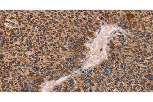 Immunohistochemistry of paraffin-embedded Human liver cancer using MMP1 Polyclonal Antibody at dilution of 1:60 (MMP1 抗体)