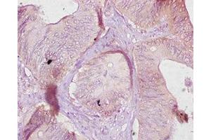 Immunohistochemistry of paraffin-embedded human colon cancer using ABIN7177073 at dilution of 1:10 (CES1C 抗体  (AA 19-550))