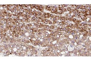 ABIN6279842 at 1/100 staining Human liver cancer tissue by IHC-P. (SLC10A4 抗体  (C-Term))