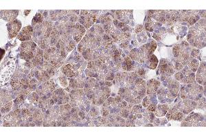 ABIN6273272 at 1/100 staining Human pancreas cancer tissue by IHC-P.