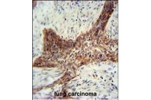 RILPL2 antibody (Center) (ABIN654981 and ABIN2844621) immunohistochemistry analysis in formalin fixed and paraffin embedded human lung carcinoma followed by peroxidase conjugation of the secondary antibody and DAB staining. (RILPL2 抗体  (AA 120-149))