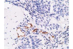 Immunohistochemical staining of paraffin-embedded Carcinoma of Human bladder tissue using anti-AFP mouse monoclonal antibody. (alpha Fetoprotein 抗体)
