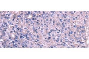 Immunohistochemistry of paraffin-embedded Human breast cancer using TRIM14 Polyclonal Antibody at dilution of 1/35 (TRIM14 抗体)