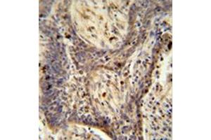 Formalin fixed and paraffin embedded human lung carcinoma reacted with PPRC1 Antibody (C-term) followed by peroxidase conjugation of the secondary antibody and DAB staining.