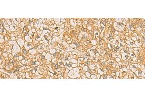 Immunohistochemistry of paraffin-embedded Human liver cancer tissue using FAAP100 Polyclonal Antibody at dilution of 1:50(x200) (C17orf70 抗体)