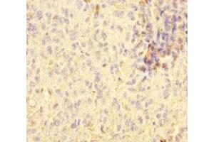 Immunohistochemistry of paraffin-embedded human melanoma using ABIN7170802 at dilution of 1:100 (STOML2 抗体  (AA 29-356))