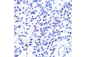 Immunohistochemistry of paraffin-embedded Human oophoroma using CHD4 antibody (ABIN6127308, ABIN6138512, ABIN6138513 and ABIN6215263) at dilution of 1:100 (40x lens). (CHD4 抗体  (AA 1520-1690))