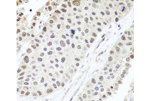 Immunohistochemistry of paraffin-embedded Human lung cancer using ALKBH4 Polyclonal Antibody at dilution of 1:100 (40x lens). (ALKBH4 抗体)