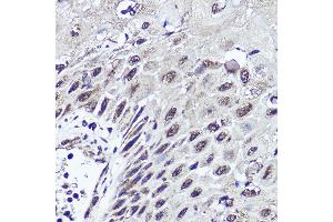 Immunohistochemistry of paraffin-embedded human esophageal cancer using CUX1 antibody (ABIN1679438, ABIN3015866, ABIN3015867 and ABIN6219446) at dilution of 1:200 (40x lens). (CUX1 抗体  (AA 1-280))