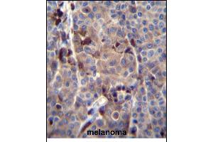 PREF8 Antibody (C-term) (ABIN656145 and ABIN2845481) immunohistochemistry analysis in formalin fixed and paraffin embedded human melanoma tissue followed by peroxidase conjugation of the secondary antibody and DAB staining. (PRAMEF8 抗体  (C-Term))