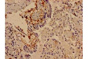 Immunocytochemistry analysis of human lung cancer using ABIN7169803 at dilution of 1:100 (SLITRK5 抗体  (AA 617-890))