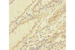 Immunohistochemistry of paraffin-embedded human colon cancer using ABIN7172031 at dilution of 1:100 (TXNL1 抗体  (AA 2-289))