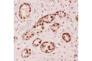 Anti-APE1 Picoband antibody,  IHC(P): Human Lung Cancer Tissue (APEX1 抗体  (AA 2-318))