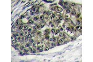IHC analysis of FFPE human breast carcinoma tissue stained with LRP6 antibody (LRP6 抗体  (AA 1531-1560))
