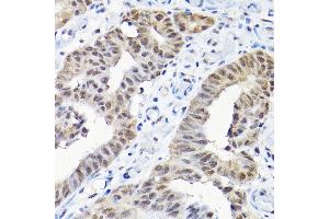 Immunohistochemistry of paraffin-embedded human colon carcinoma using SNRPF Rabbit pAb (ABIN6132678, ABIN6148228, ABIN6148229 and ABIN6215753) at dilution of 1:200 (40x lens). (SNRPF 抗体  (AA 1-86))