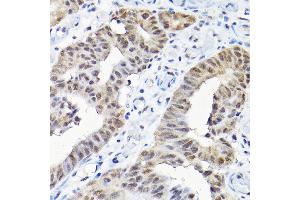 Immunohistochemistry of paraffin-embedded human colon carcinoma using SNRPF Rabbit pAb (ABIN6132678, ABIN6148228, ABIN6148229 and ABIN6215753) at dilution of 1:200 (40x lens). (SNRPF 抗体  (AA 1-86))