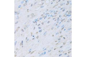 Immunohistochemistry of paraffin-embedded human liver cancer using KAT2A antibody. (KAT2A 抗体)