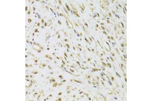 Immunohistochemistry of paraffin-embedded human leiomyoma of uterus using DDX1 Antibody (ABIN5973950) at dilution of 1/100 (40x lens). (DDX1 抗体)