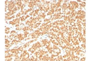Formalin-fixed, paraffin-embedded human Colon Carcinoma stained with ICOSL-Monospecific Mouse Monoclonal Antibody (ICOSL/3260). (ICOSLG 抗体  (AA 23-149))
