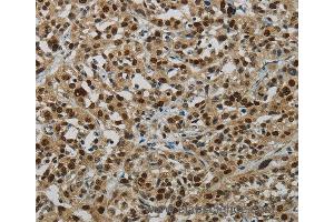 Immunohistochemistry of Human breast cancer using LIG1 Polyclonal Antibody at dilution of 1:70 (LIG1 抗体)