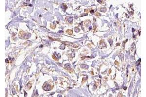 ABIN6276874 at 1/100 staining Human breast cancer tissue by IHC-P. (HMBS 抗体  (Internal Region))