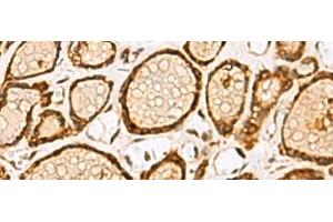 Immunohistochemistry of paraffin-embedded Human thyroid cancer tissue using LRRC2 Polyclonal Antibody at dilution of 1:55(x200) (LRRC2 抗体)