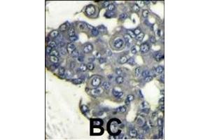 Formalin-fixed and paraffin-embedded human breast carcinoma reacted with PI3KCD Antibody (N-term) (ABIN392564 and ABIN2842107) , which was peroxidase-conjugated to the secondary antibody, followed by DAB staining. (PIK3CD 抗体  (N-Term))
