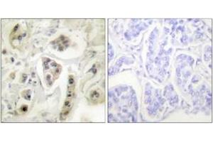 Immunohistochemistry analysis of paraffin-embedded human lung carcinoma tissue, using HSP60 Antibody. (HSPD1 抗体  (AA 511-560))