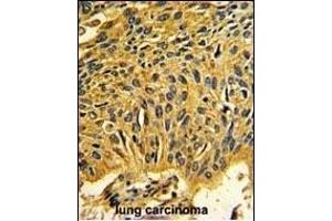 Formalin-fixed and paraffin-embedded human lung carcinoma reacted with CDK2 Antibody (C-term), which was peroxidase-conjugated to the secondary antibody, followed by DAB staining. (CDK2 抗体  (C-Term))