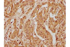 IHC image of ABIN7140235 diluted at 1:300 and staining in paraffin-embedded human liver cancer performed on a Leica BondTM system. (WFIKKN1 抗体  (AA 187-207))