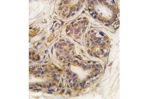 Formalin-fixed and paraffin-embedded human breast carcinoma tissue reacted with CASC3 Antibody , which was peroxidase-conjugated to the secondary antibody, followed by DAB staining. (CASC3 抗体  (Tyr181))