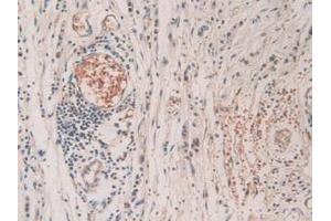 IHC-P analysis of Human Stomach Cancer Tissue, with DAB staining. (SHC3 抗体  (AA 188-433))