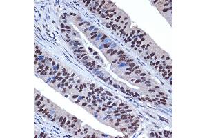 Immunohistochemistry of paraffin-embedded human colon carcinoma using WDR4 Rabbit mAb (ABIN7271355) at dilution of 1:100 (40x lens). (WDR4 抗体)