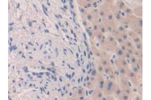 Detection of FGF19 in Human Liver cancer Tissue using Polyclonal Antibody to Fibroblast Growth Factor 19 (FGF19) (FGF19 抗体  (AA 4-216))