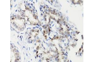 Immunohistochemistry (Paraffin-embedded Sections) (IHC (p)) image for anti-Signal Transducer and Activator of Transcription 3 (Acute-Phase Response Factor) (STAT3) (pSer727) antibody (ABIN7265216)