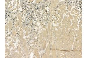 ABIN6264824 and ABIN6276917 at 1/100 staining human tongue carcinoma by IHC-P. (RPGR 抗体  (C-Term))