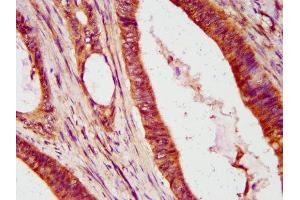 IHC image of ABIN7156667 diluted at 1:600 and staining in paraffin-embedded human colon cancer performed on a Leica BondTM system. (IFIT2 抗体  (AA 130-265))