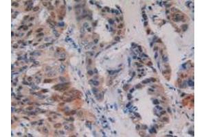 Detection of PKD1 in Human Breast Cancer Tissue using Polyclonal Antibody to Protein Kinase D1 (PKD1) (PKC mu 抗体)