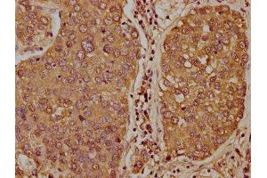 IHC image of ABIN7171357 diluted at 1:400 and staining in paraffin-embedded human liver cancer performed on a Leica BondTM system. (TCL1B 抗体  (AA 1-128))