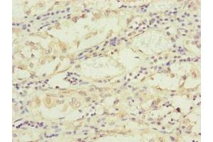 Immunohistochemistry of paraffin-embedded human gastric cancer using ABIN7159902 at dilution of 1:100 (TIMM17B 抗体  (AA 1-172))
