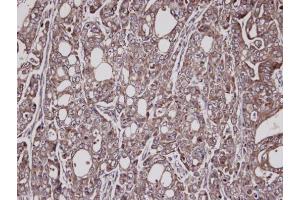 IHC-P Image Immunohistochemical analysis of paraffin-embedded NCI-N87 xenograft, using Lysyl-tRNA synthetase, antibody at 1:100 dilution. (KARS 抗体)
