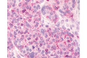 Anti-FKSG80 / GPR81 antibody IHC of human Ovary, Carcinoma. (GPR81 抗体  (Extracellular Domain))