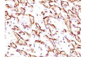 IHC testing of angiosarcoma stained with Podocalyxin antibody. (PODXL 抗体  (Extracellular Domain))