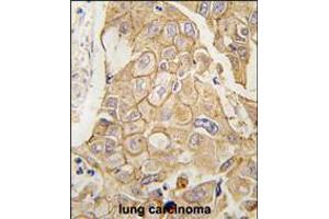 Formalin-fixed and paraffin-embedded human lung carcinoma tissue reacted with ADCY2 antibody , which was peroxidase-conjugated to the secondary antibody, followed by DAB staining.