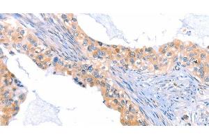 Immunohistochemistry of paraffin-embedded Human cervical cancer tissue using THBS1 Polyclonal Antibody at dilution 1:60 (Thrombospondin 1 抗体)