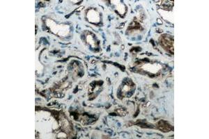Immunohistochemical analysis of Aquaporin 4 staining in human lung cancer formalin fixed paraffin embedded tissue section. (Aquaporin 4 抗体  (Center))