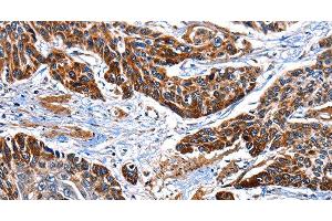 Immunohistochemistry of paraffin-embedded Human esophagus cancer tissue using ITGA7 Polyclonal Antibody at dilution 1:35 (ITGA7 抗体)