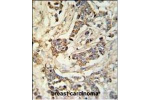 MR Antibody (N-term) 9980a IHC analysis in formalin fixed and paraffin embedded breast carcinoma followed by peroxidase conjugation of the secondary antibody and DAB staining. (MRAP 抗体  (N-Term))