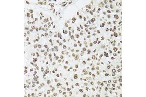 Immunohistochemistry of paraffin-embedded human esophageal cancer using SFPQ antibody.